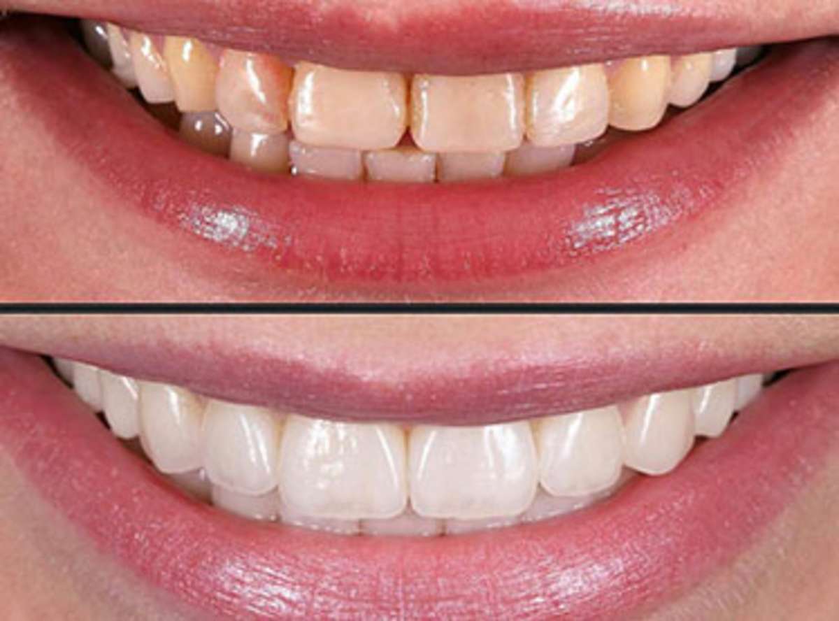 Margaret W. - Calgary - Smile Design (20 Veneers)
