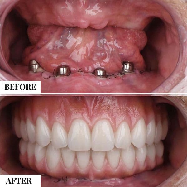 Porcelain Veneers - photo 2