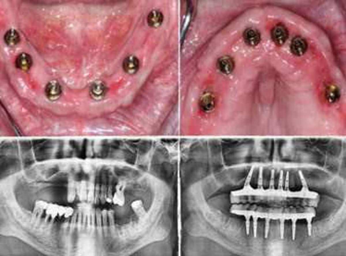 Single Tooth Implant