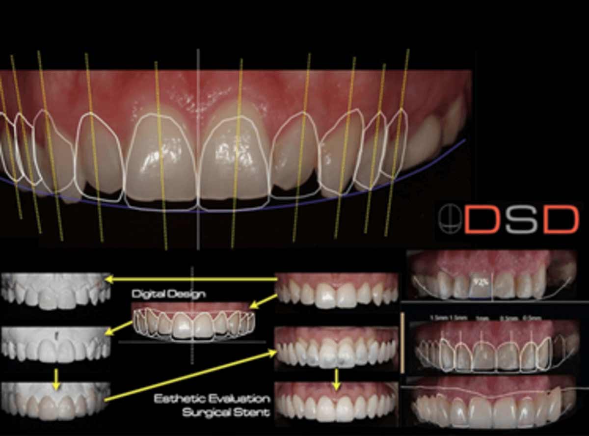 The Dental Tourism Process: From Consultation to Restoration