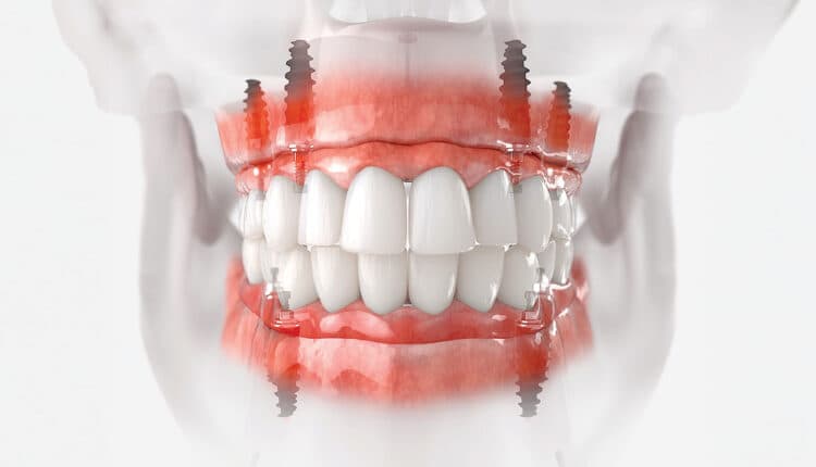 Full Mouth Rehabilitation