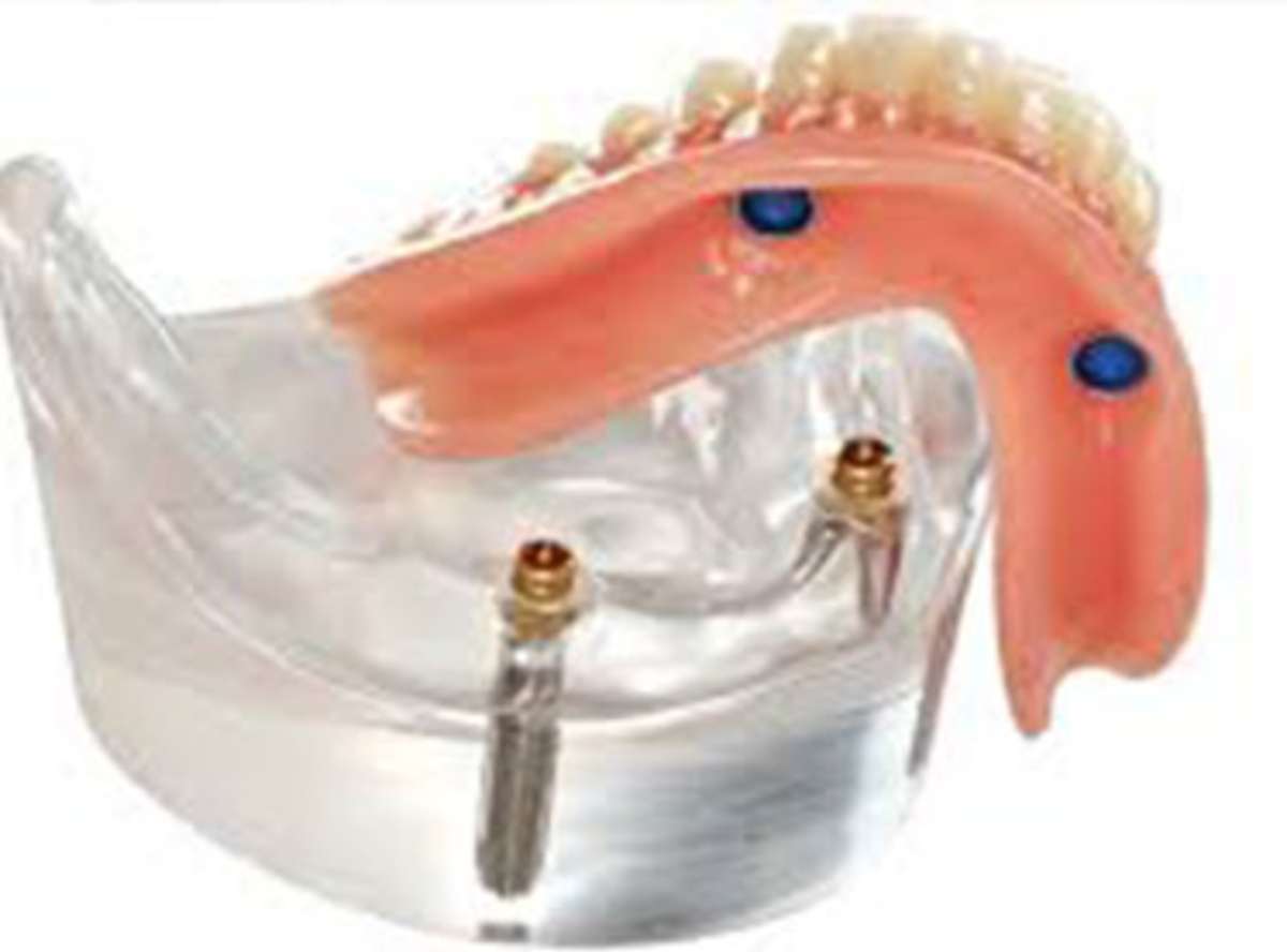 Why Consider an Overdenture?