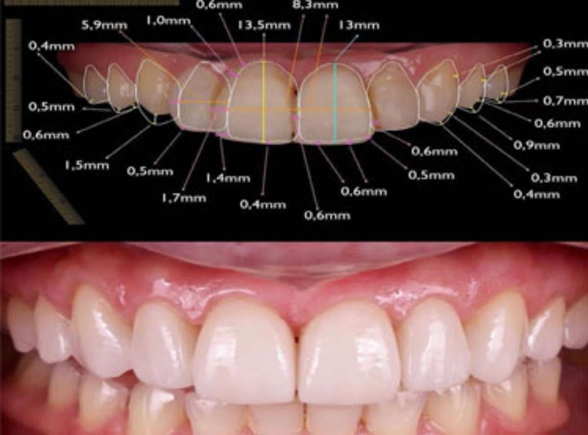 Digital smile design 3D preview before veneer placement