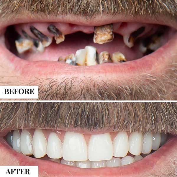 Full mouth rehabilitation case comparing dental tourism options