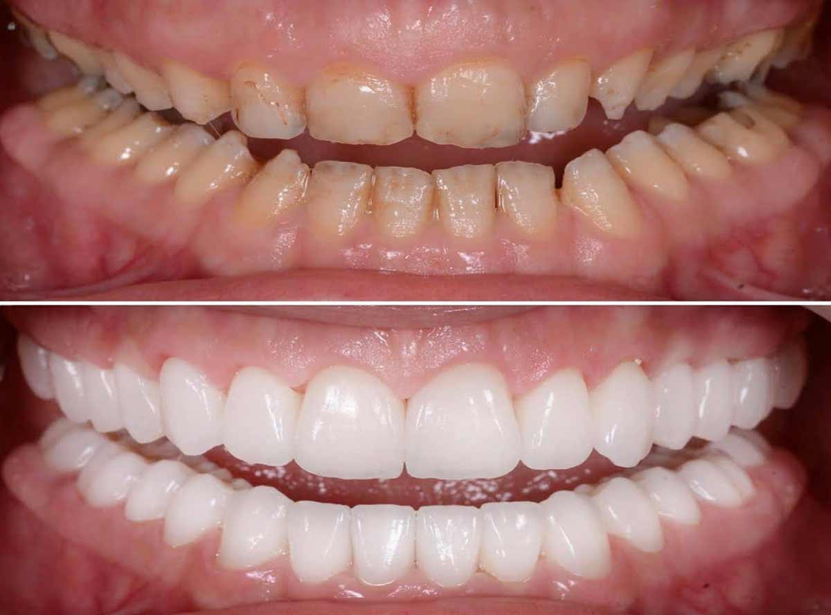 When Is Full-Mouth Rehabilitation Indicated?