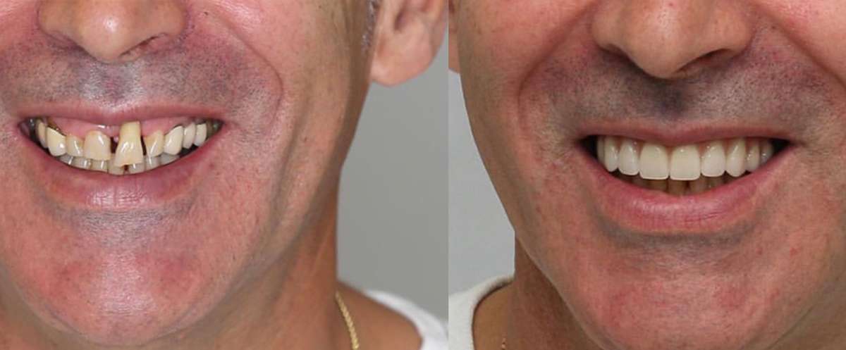 FMR Modality Comparison: Tooth-Supported, Implant-Supported, Hybrid