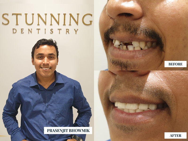 Dental Implants — photo 4