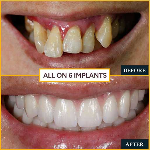 Porcelain Veneers — photo 4