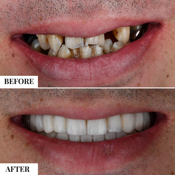 Dental Implants — photo 1