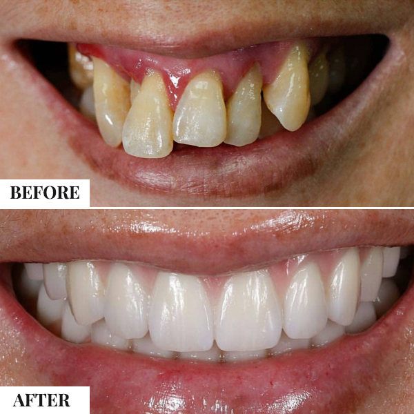 Dental Implants — photo 2