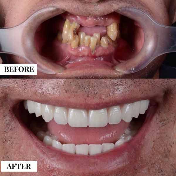 Dental Implants — photo 3