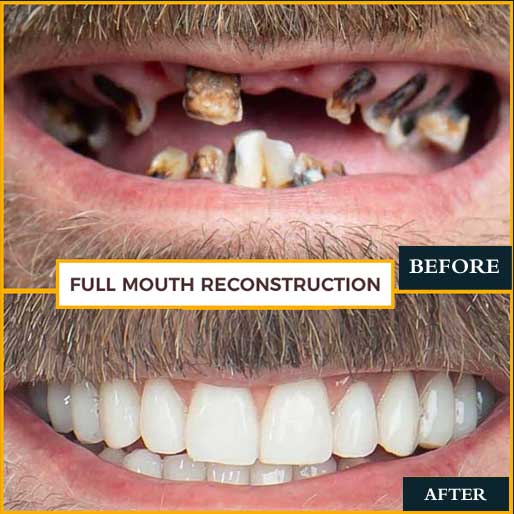 Full Mouth Rehabilitation — photo 4
