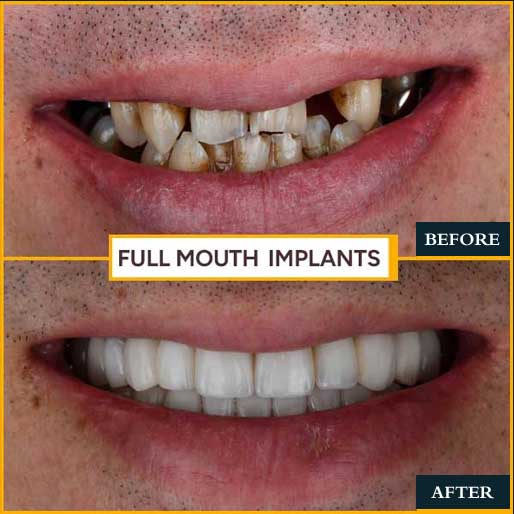 Smile Makeover — photo 2