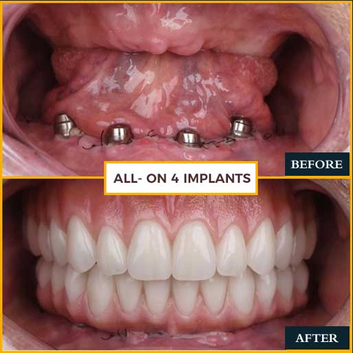 Smile Makeover — photo 3