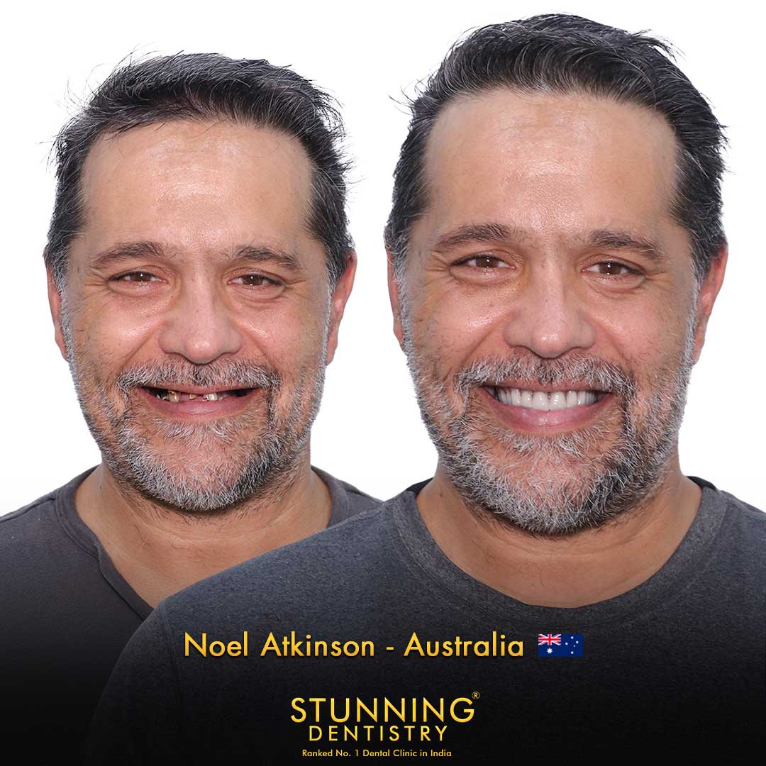 Porcelain Veneers — photo 1