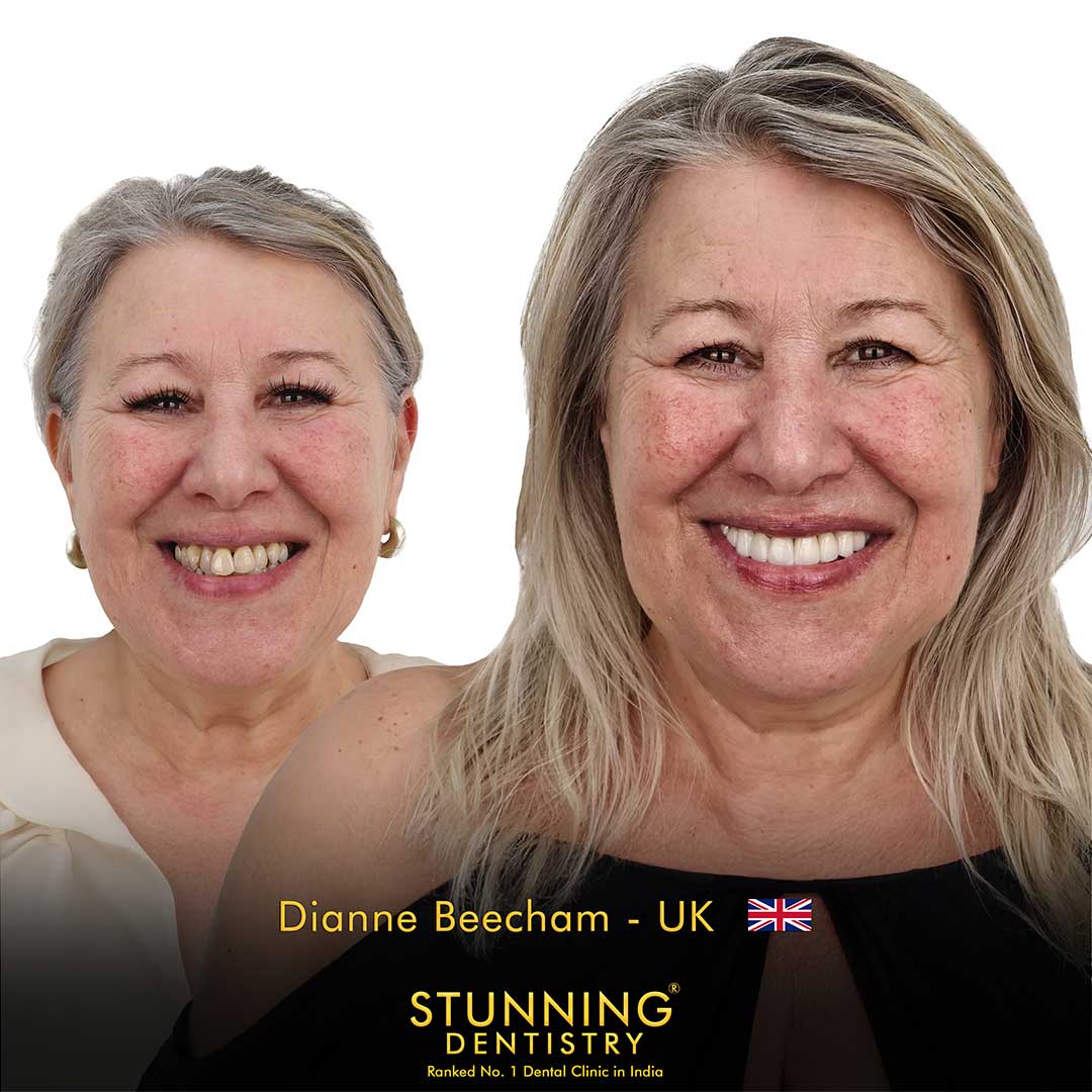 Porcelain Veneers — photo 2