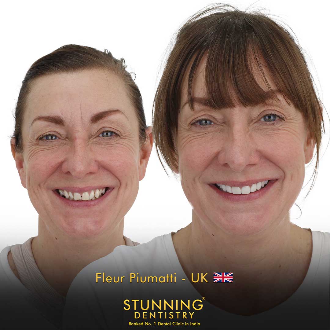 Porcelain Veneers — photo 3