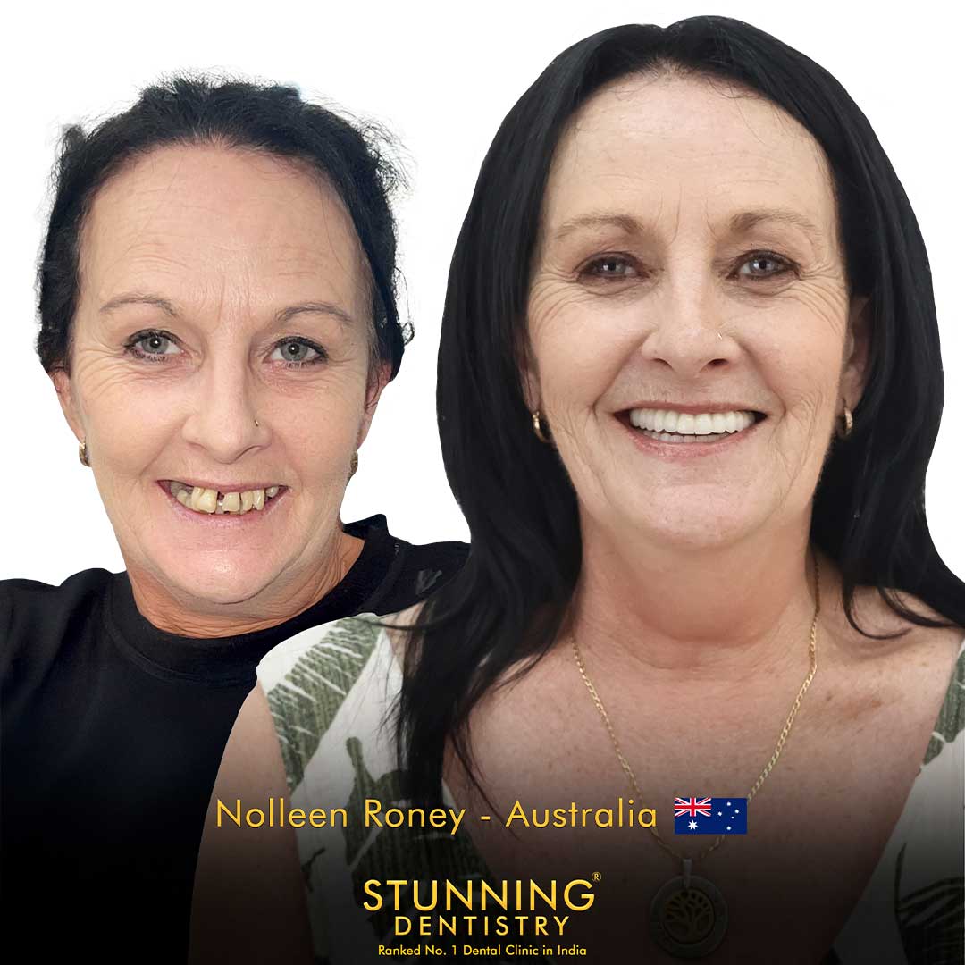 Full Mouth Rehabilitation — photo 1