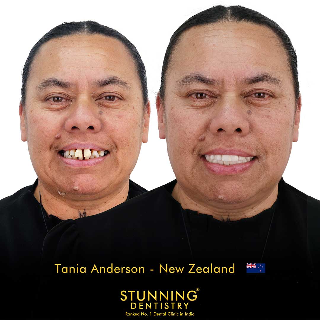 Smile Makeover — photo 1